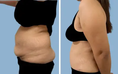Before and After